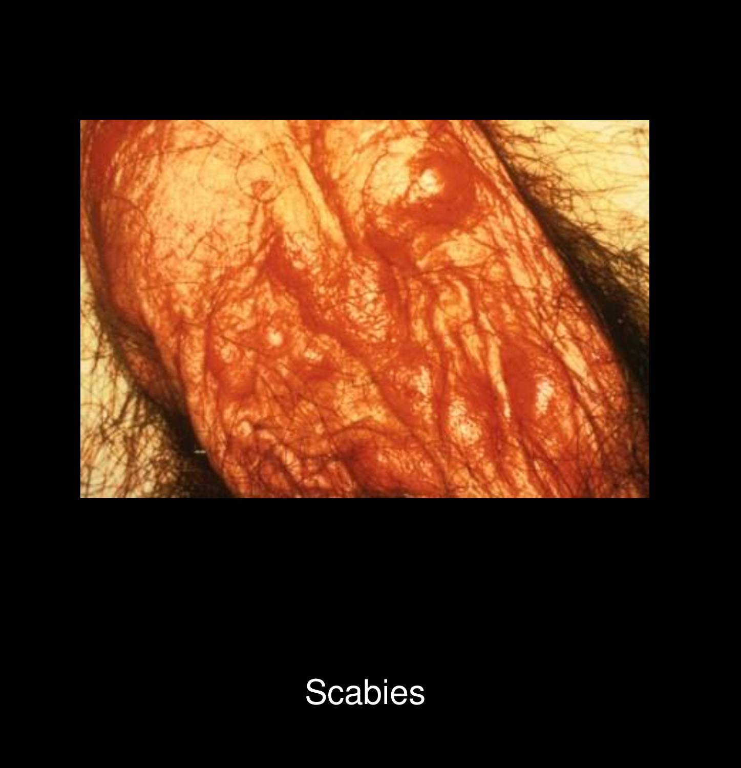 Crusted Norwegian scabies showing hyperkeratotic plaques with thick crusts containing thousands of mites in immunocompromised patient